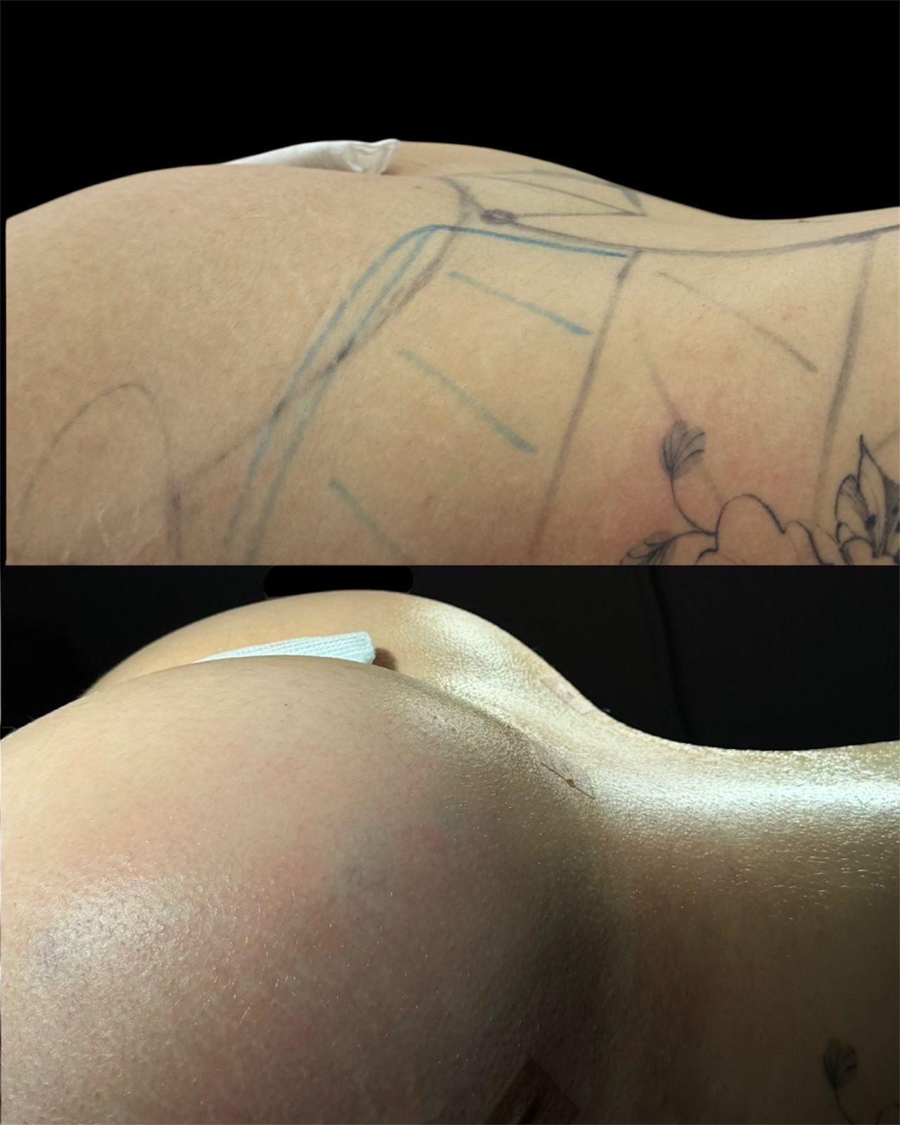 lipo-em-curitiba